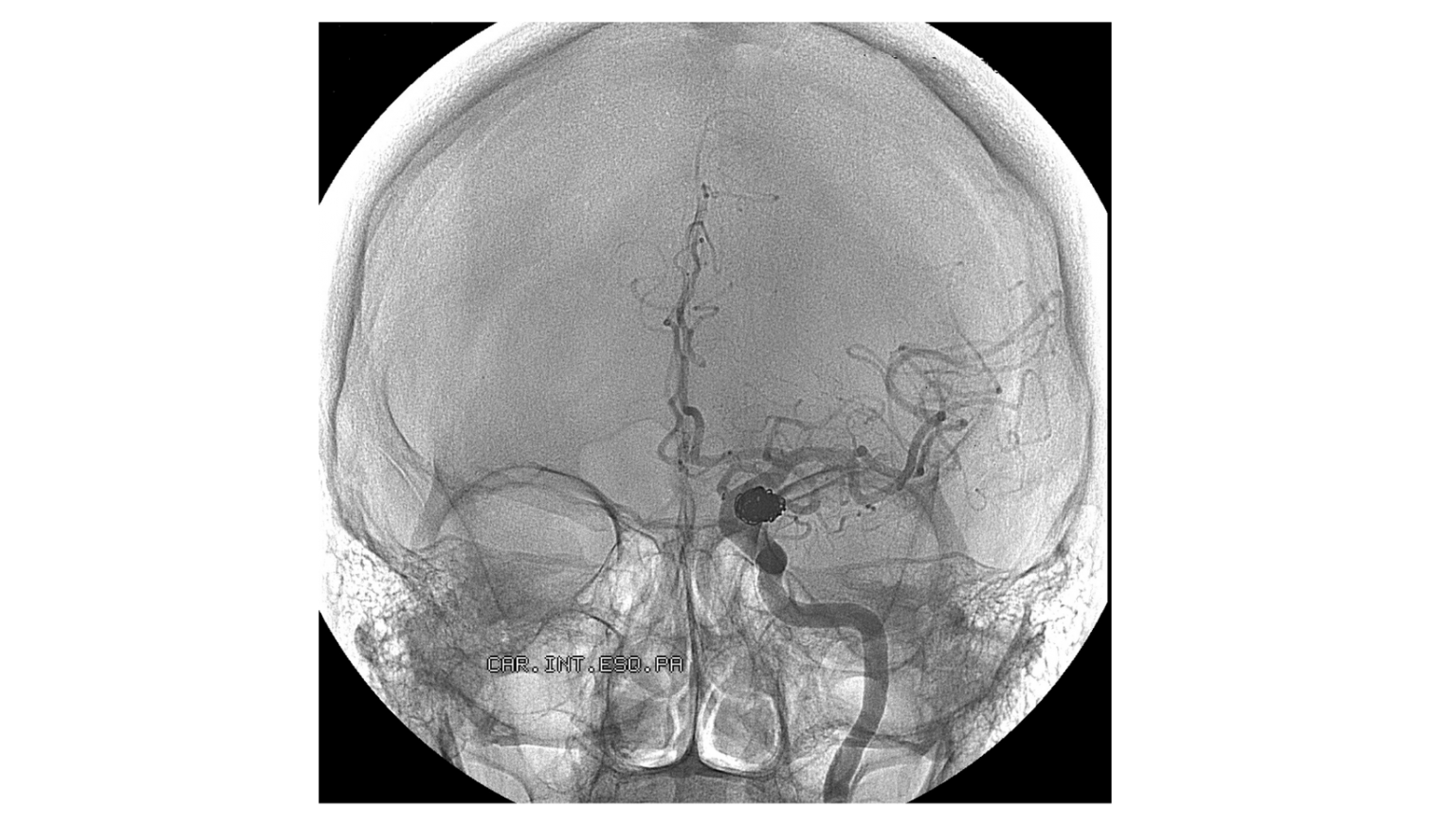 about-aneurysm-sim-and-cure